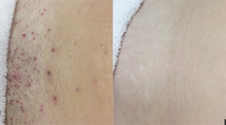 Avant après épilation laser - Irritations